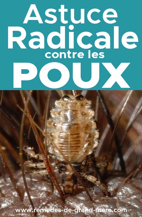 astuce radicale contre les poux